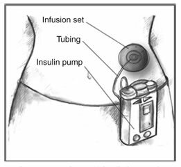 Insulinpumpe
