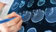 3D-hjernescanninger kan øge nøjagtigheden af ​​ADHD-diagnose